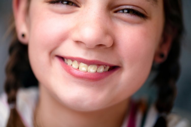 Fillette souriante avec des taches blanches sur les dents comme signe de l'apparence d'une fluorose dentaire.