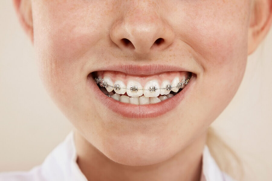 How common is caries with fixed braces?