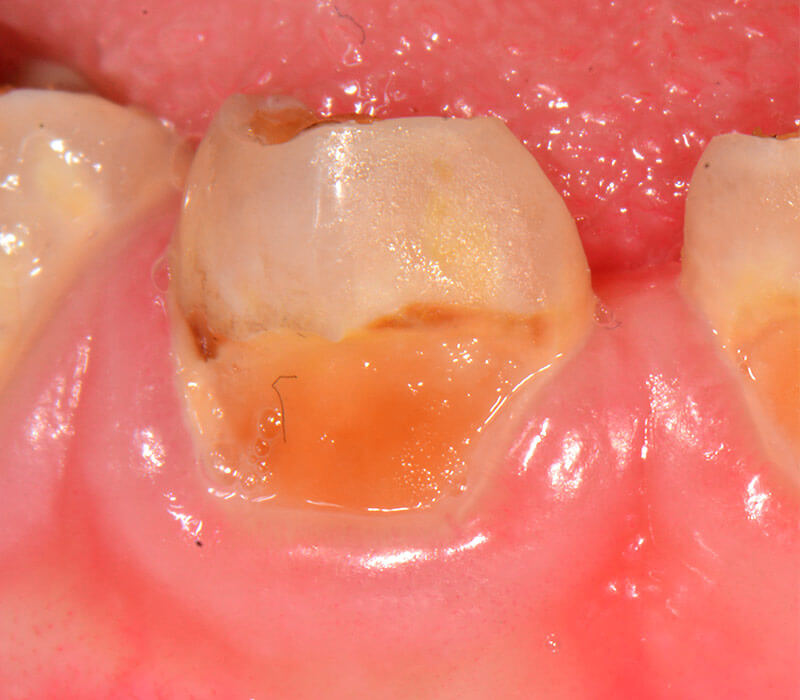 Zahn 83 mit einer deutlich sichtbaren Karies