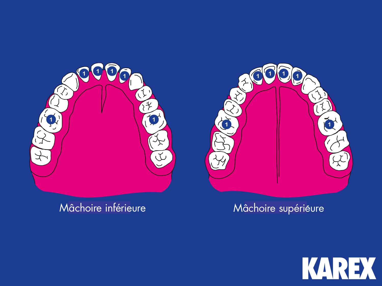 Représentation schématique de la mâchoire supérieure et de la mâchoire inférieure pour illustrer la première phase du changement de dents chez les enfants.
