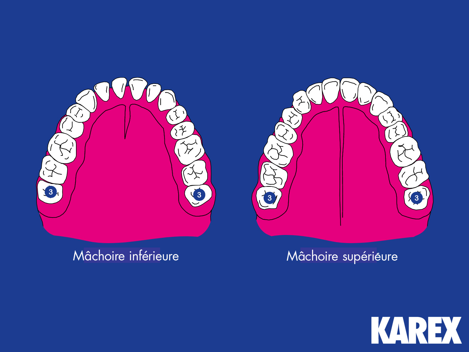 Représentation schématique de la mâchoire supérieure et de la mâchoire inférieure pour illustrer la troisième phase du changement de dents chez les enfants.