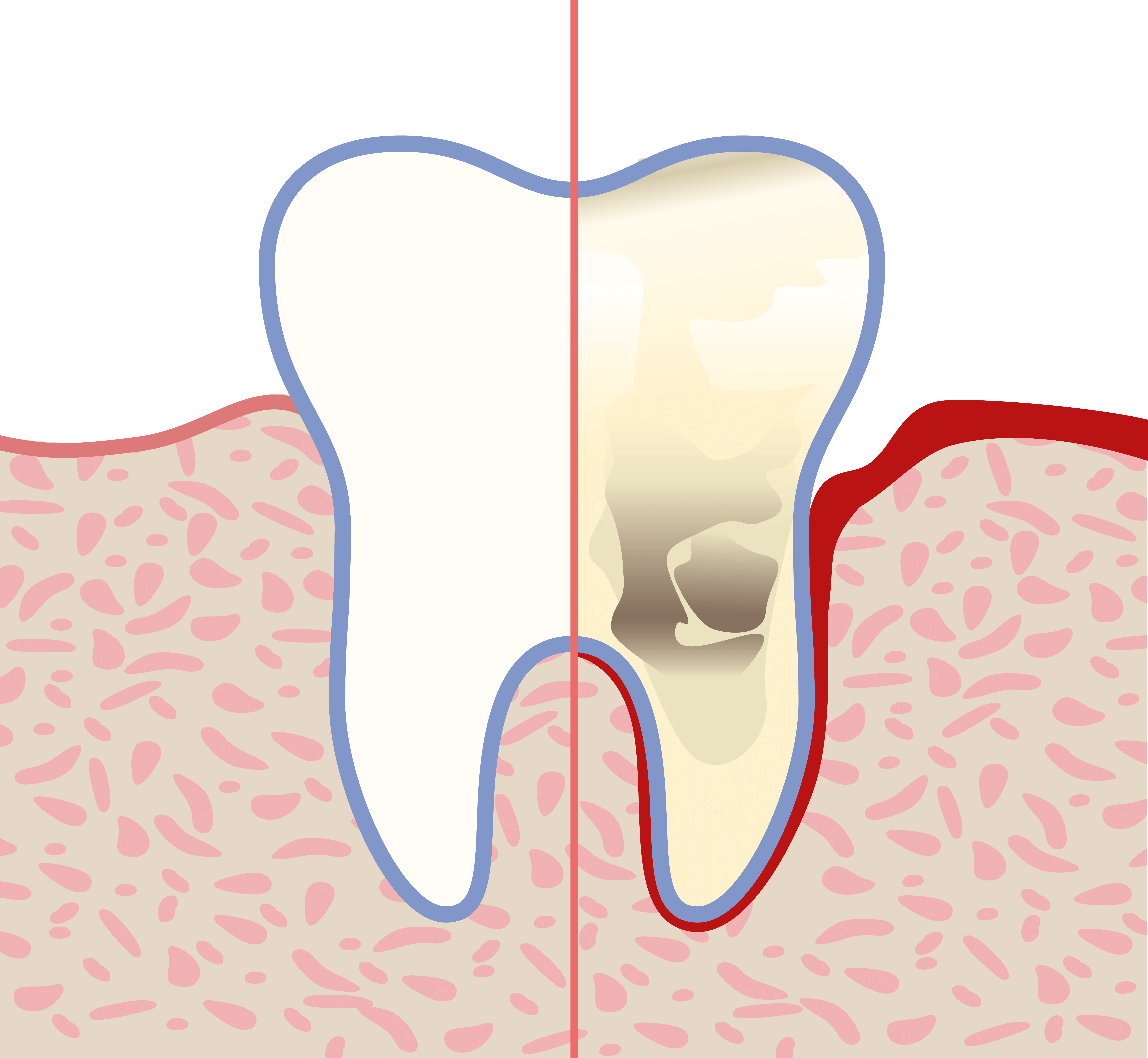 Plaque as a cause of gum inflammation