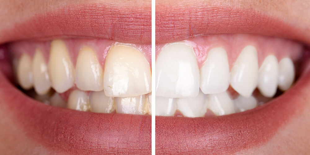 Tooth discolouration and tooth whitening
