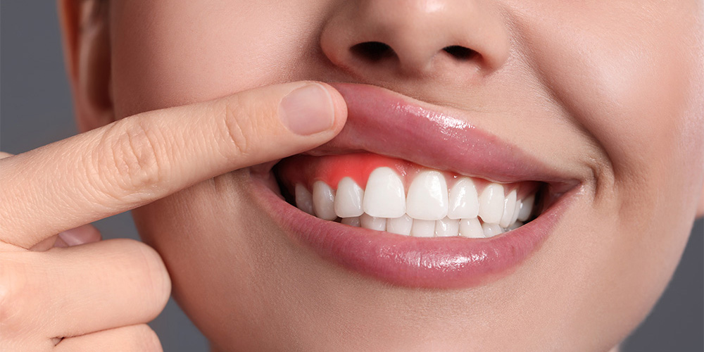 Zahnfleischentzündung: Gingivitis oder Parodontitis?